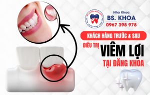 Điều Trị Viêm Lợi Tại Tây Ninh 01
